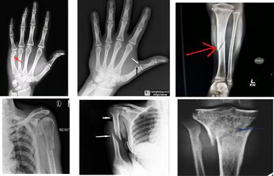 Diagnosis and detection of bone fracture in radiographic images using deep learning approaches